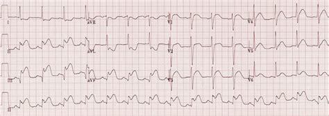 Inferior STEMI • LITFL • ECG Library Diagnosis