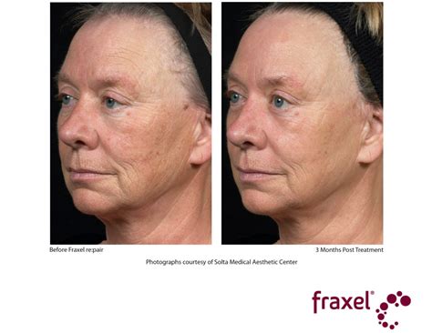 fraxel_repair_1 | Cosmetic Laser Centers