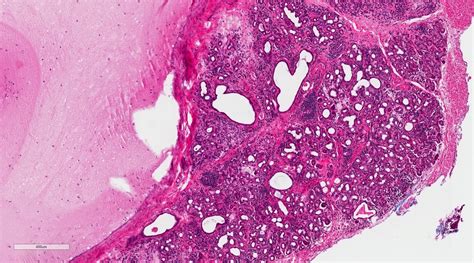 Mucocele Histology