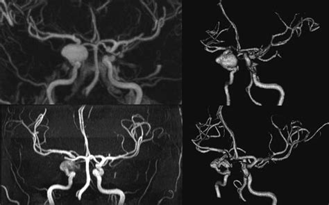 Contrast-Enhanced MR Angiography at 3T in the Evaluation of ...