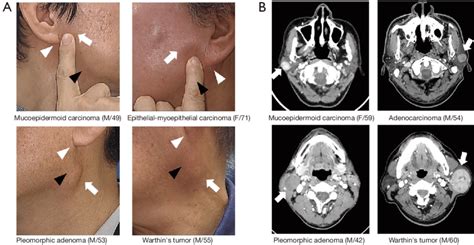 Parotid Tumor