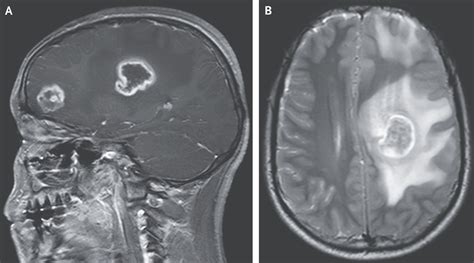 Boy's Brain Started to Rot After Rare Parasitic Infection - Newsweek