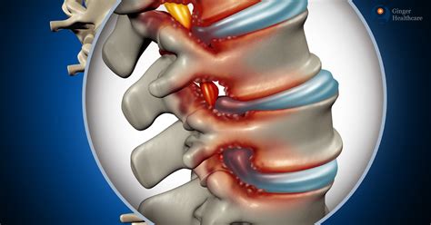 Laminectomy: Indications, Types, Preparation, Procedure, Complications ...