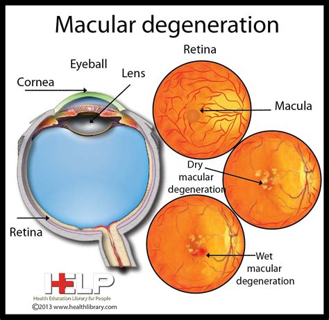 Macular Degeneration Eye Health Facts, Eye Facts, Nursing Study ...