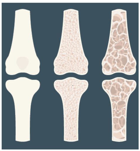 Should YOU Worry About Osteoporosis? - Tufts Health & Nutrition Letter