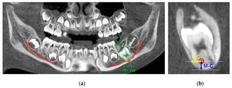 Mandibular Foramen Radiograph