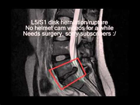 L5/S1 disk herniation - YouTube