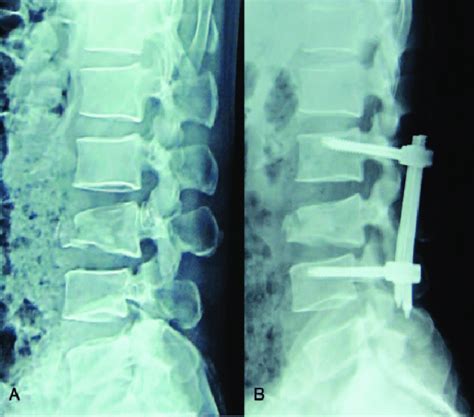 Male, 42 years old, L3 vertebral fracture (type B2): x-ray showed ...