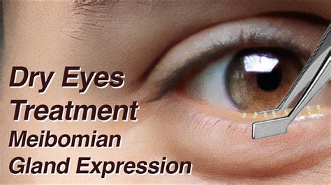 Dry Eyes Treatment with Meibomian Gland Expression (MGD) - YouTube