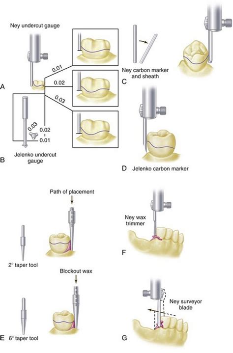 11: Surveying | Pocket Dentistry