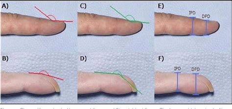 Figure 3 from Examination for Finger Clubbing | Semantic Scholar