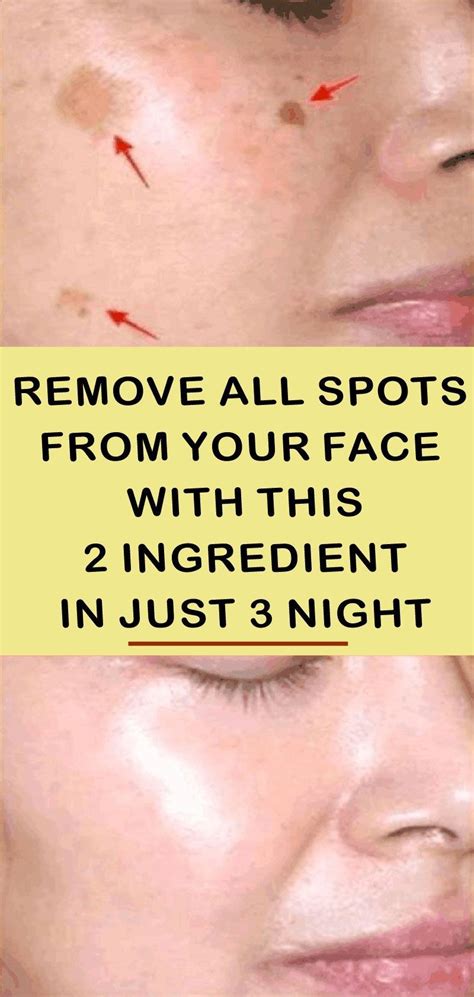 Removes All Spots On Your Face In Just 3 Nights | Remove dark spots ...