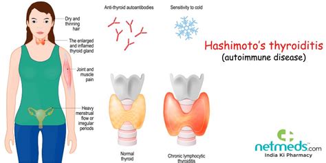 Hashimoto’s Disease: Causes, Symptoms And Treatment