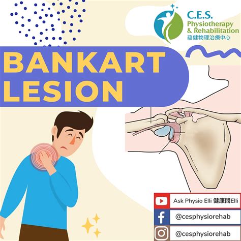 What is Bankart Lesion?