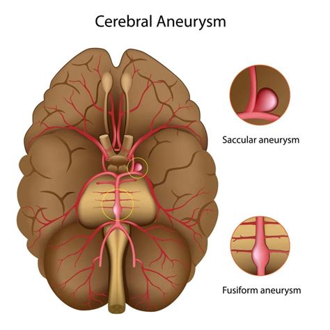 What You Need to Know About Brain Aneurysms - Premier Neurology ...