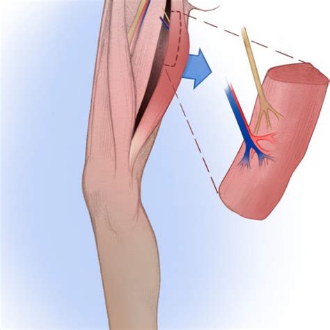 A 46-year-old male who underwent single-stage dual innervation gracilis ...