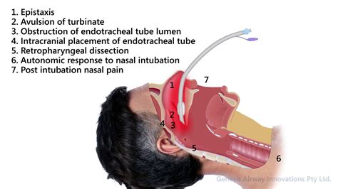 Complications of Nasal Endotracheal Intubation - YouTube