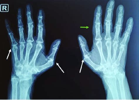 X-Ray shows ulnar deviation of both hands, subluxations of the 1st and ...