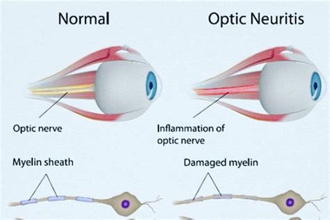 Optic Neuritis: Symptoms, Causes, and Treatments