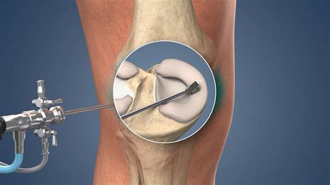 Repairing Torn Meniscus With Meniscus Repair Systems Market – Polaris ...