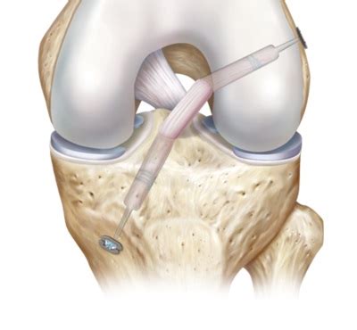 ACL and PCL | Knee Repair or Reconstructive Surgery | Free consultation