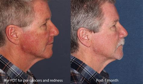 Photodynamic Therapy Acne Treatment | San Diego, CA | CLDerm