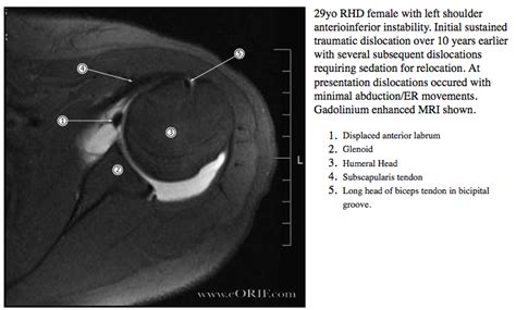 Bankart Repair Arthroscopic 29806 | eORIF