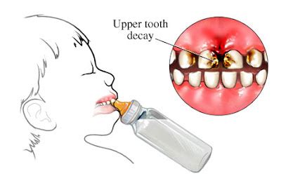 Making People Smile: Baby Bottle Tooth Decay