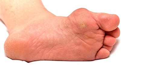 What is a bunion? Bunions explained by Perth Podiatrists in Scotland