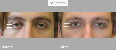 Almond Eye Surgery Before and After Gallery | Taban MD