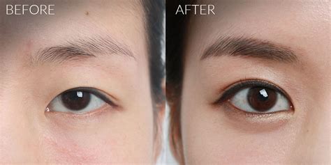 single eyelid surgery Cheaper Than Retail Price> Buy Clothing ...