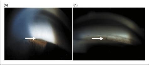 (a) Gonioscopy showing closed angles, (b) gonioscopy showing angle ...