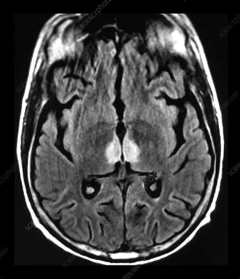 Photograph Wernicke S Encephalopathy Mri Science Source Images | The ...