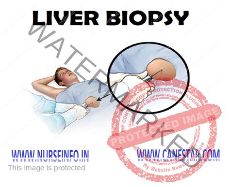 LIVER BIOPSY - Nurse Info