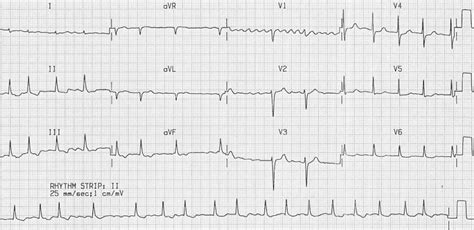 Atrial Fibrillation • LITFL • ECG Library Diagnosis