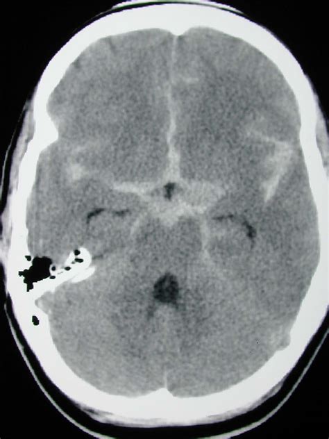 Subarachnoid hemorrhage - Cancer Therapy Advisor