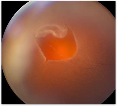 Lattice Degeneration - Retina-Vitreous Surgeons of CNY