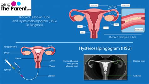 Hysterosalpingography When And Why Is It Done - Being The Parent