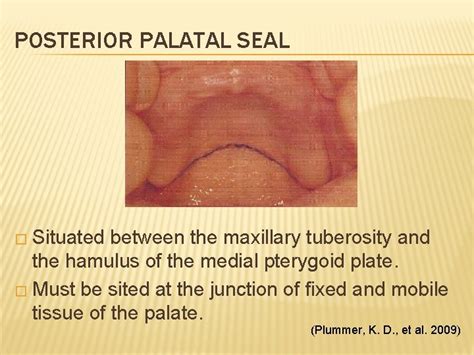 POSTERIOR PALATAL SEAL PPS IN COMPLETE DENTURE POSTERIOR