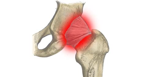 Hip Synovitis - Symptoms, Causes, Treatment & Rehabilitation