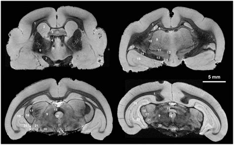 1: corpus callosum; 2: caudate nucleus; 3: septal nuclei; 4: thalamic ...