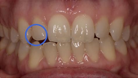 Splint for anterior open-bite distortion - Elizabeth Caughey ...