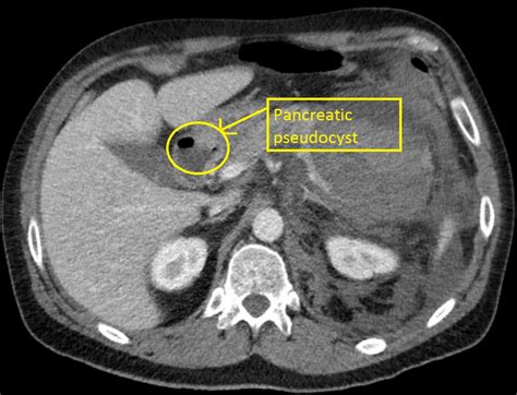 Chronic pancreatitis CT - wikidoc