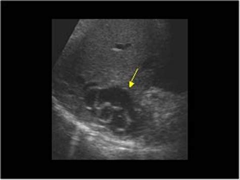 Abdomen and retroperitoneum | 1.1 Liver : Case 1.1.5 Hydatid cysts ...