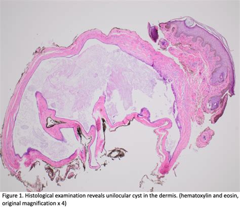 Apocrine Hidrocystoma of the Upper Eyelid