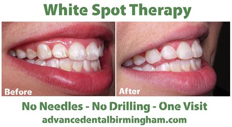 What are white spots on teeth and what can you do about them? - AdVance ...