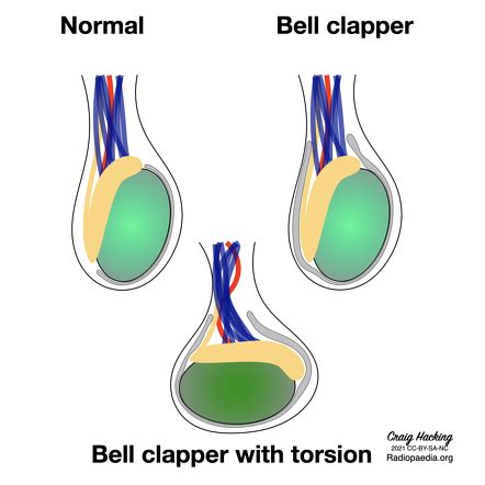 Bell clapper deformity (diagram) | Image | Radiopaedia.org