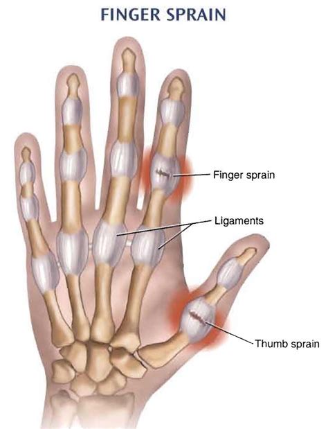 Neat Tips About How To Heal Sprained Finger - Householdother