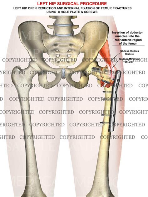 Left femur intertrochanteric fracture - ORIF – Medical Art Works