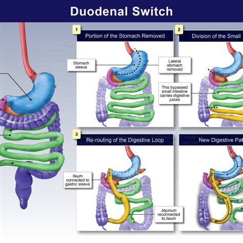 Duodenal Switch - TrialExhibits Inc.